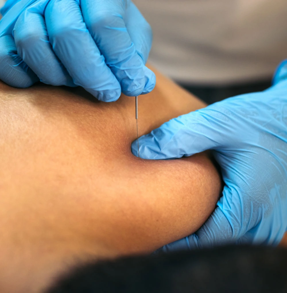 IMS Dry Needling Email LP 2 image 2